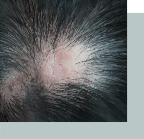 Alopecia In Men Kensington Hair Clinic