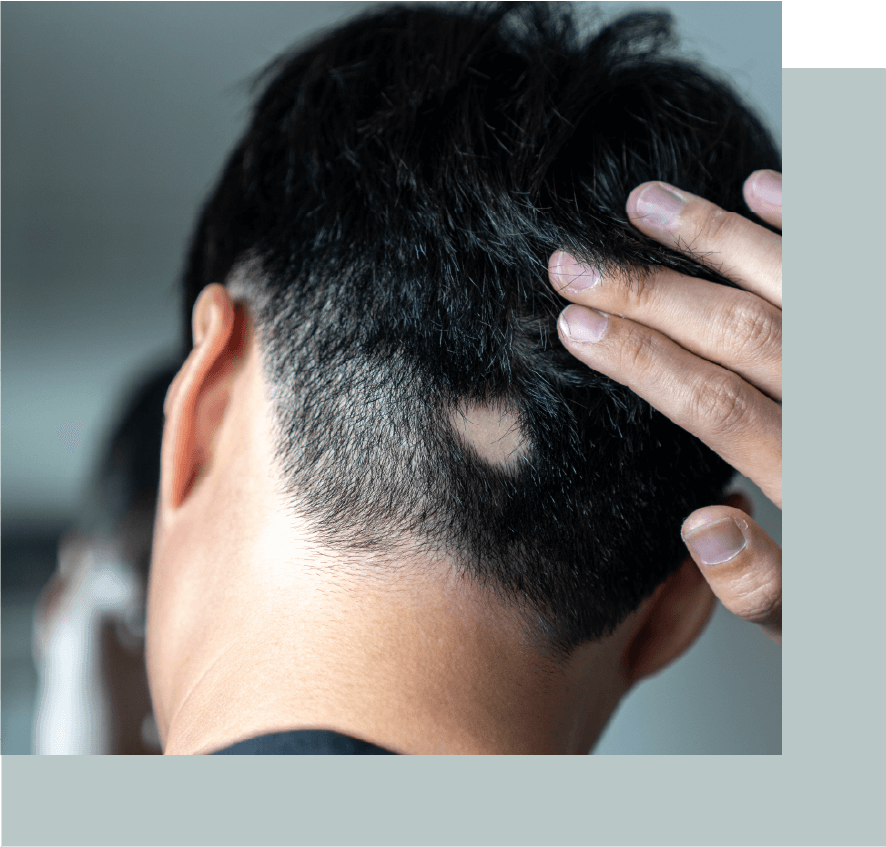 Alopecia in men Kensington Hair Clinic