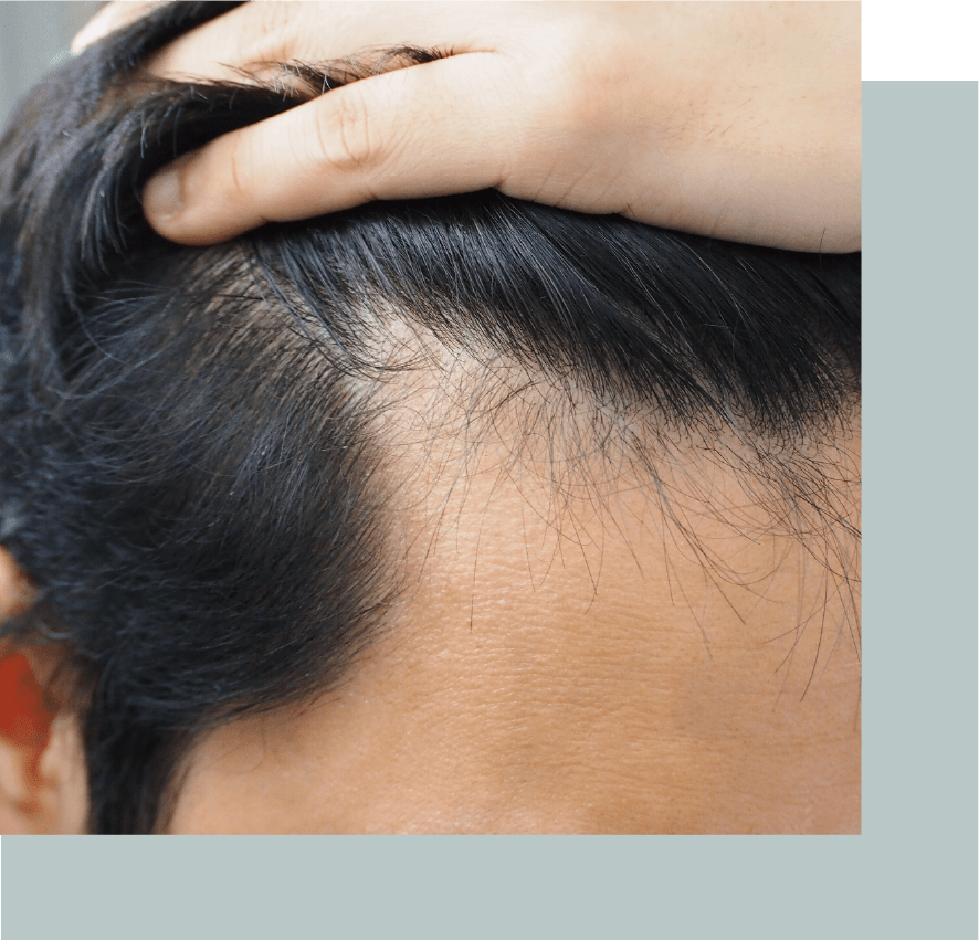 Alopecia in men Kensington Hair Clinic