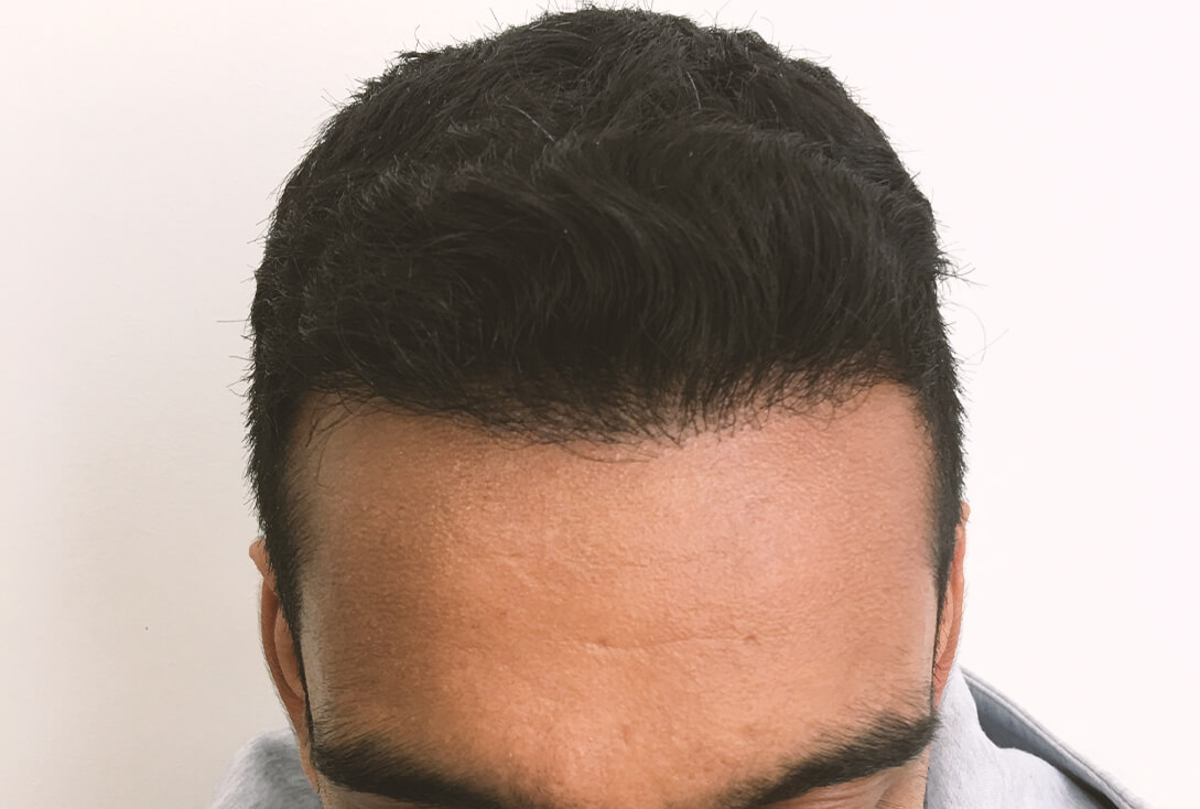 Before and After Hair Restoration - Kensington Hair Clinic Before and After Hair Restoration - Kensington Hair Clinic